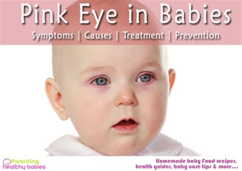 Pink Eye in Babies: Symptoms, Causes, Treatment and Prevention