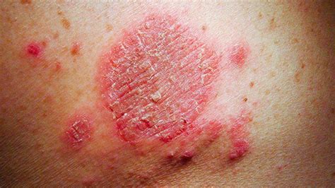 Eczema In Pictures: What Do the Types Look Like?