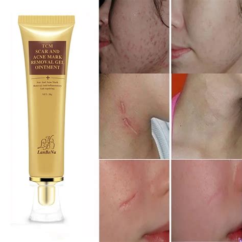 Face Beauty Scar Removal Cream Skin Repair 30ml Face Cream Blemish Spots Treatment Blackhead ...