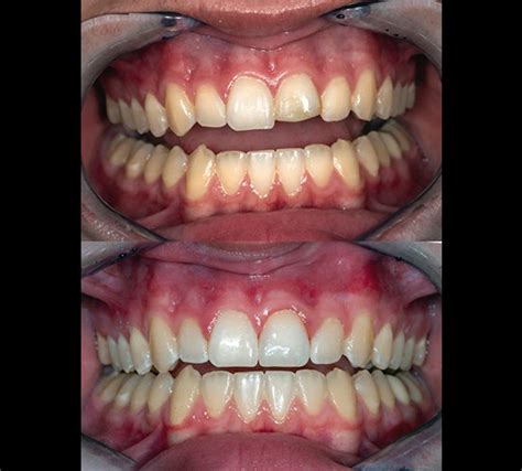 Smile Gallery | Before & Afters | Infinite Smiles Dentistry