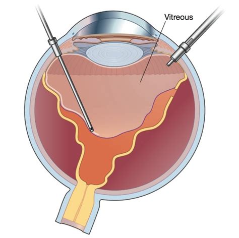 Choroidal Nevus | Benign Retina Growth | Retina Specialist Orange County