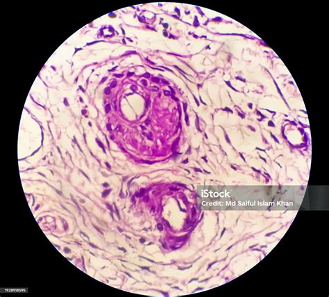 Histology Peritoneal Inclusion Cyst Paraovarian Cysts Hydrosalpinx And Lowgrade Cystic ...