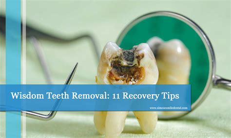 Wisdom Teeth Removal: 11 Recovery Tips