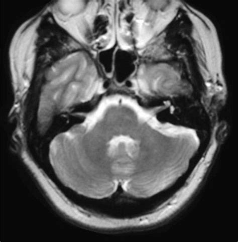 Normal Axial pons