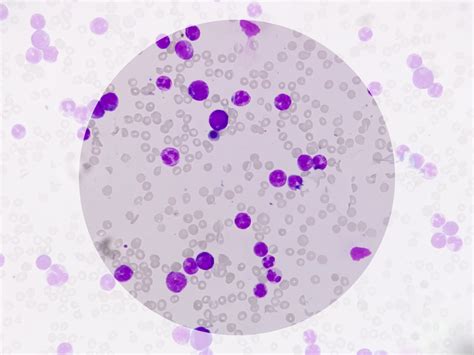 What do Leukocytes in Urine mean?