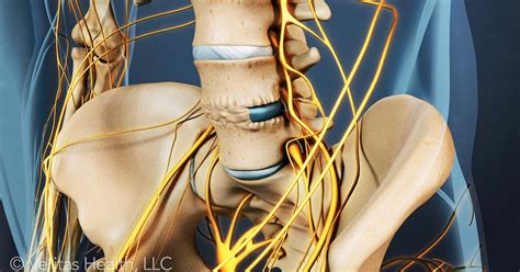 Spinal Fusion Surgery Recovery: One to Three Months Post-Operation