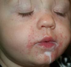 How to treat baby teething rash | Intelligent Dental