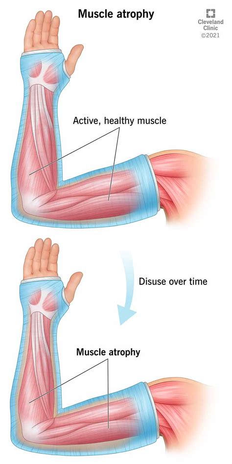 Muscle Atrophy: Causes, Symptoms & Treatment