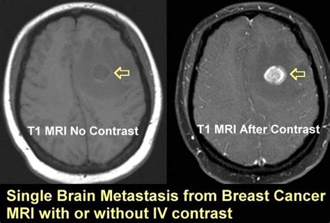 MRIs and contrast gadolinium | Powerful Patient