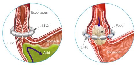 Linx Device for Acid Reflux | Comanche County Memorial Hospital