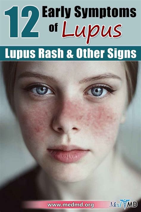 12 Early Symptoms of Lupus - Lupus Rash & Other Signs | Lupus rash ...