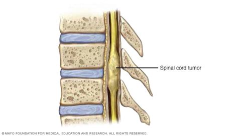 Overview - Spinal cord tumor - Mayo Clinic