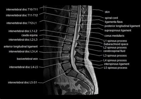 MRI lumbar spine sagittal cross sectional anatomy image 6 | Mri, Anatomy images, Diagnostic imaging