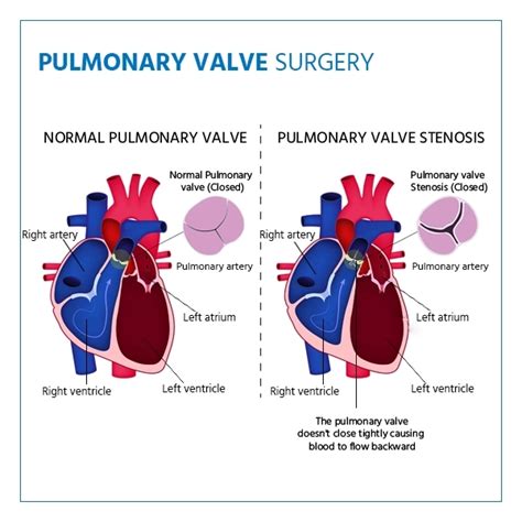 Pulmonary Valve Surgery - Recovery, Lifestyle Changes.