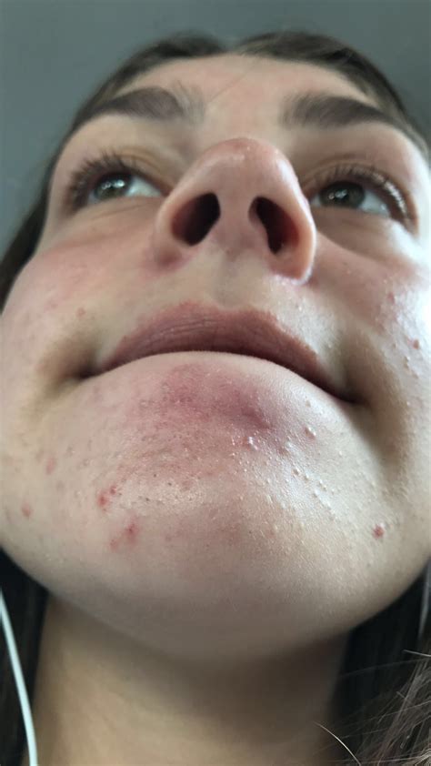 Tiny bumps all over my forehead and mainly on my chin – General acne discussion – Acne.org Forum