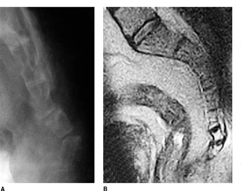 coccydynia | Semantic Scholar