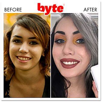 Byte Aligners: 21 Before & After Photos (Pics of Real Results!) | Byte, Teeth alignment ...