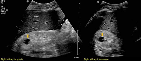 Ultrasound features of Kidney Cysts - Renal Fellow Network