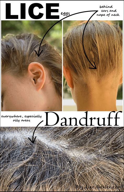 Lice vs Dandruff - 7 Key Differences Between Lice Eggs and Dandruff