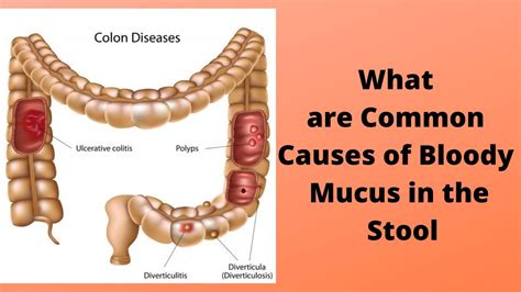 Causes Of Blood In Mucus