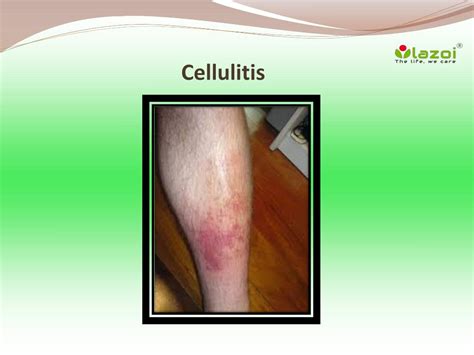 Cellulitis Causes