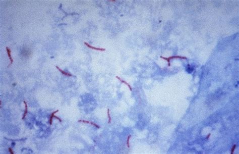 Ziehl-Neelsen Staining- Principle and Procedure with Results