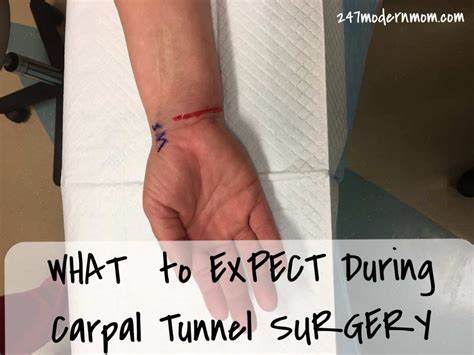 Carpal Tunnel Surgery: What to Expect During the Procedure