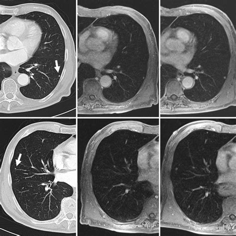 A 40-year-old woman with pulmonary hamartoma. (A) CT image shows... | Download Scientific Diagram