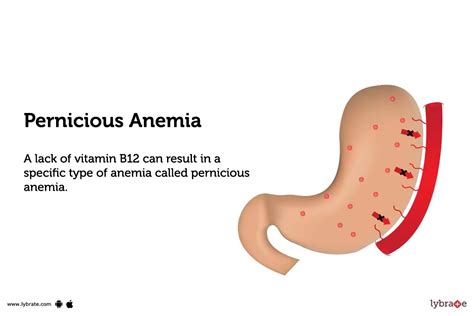 Pernicious Anemia: Definition, Symptoms, Causes Treatment, 40% OFF