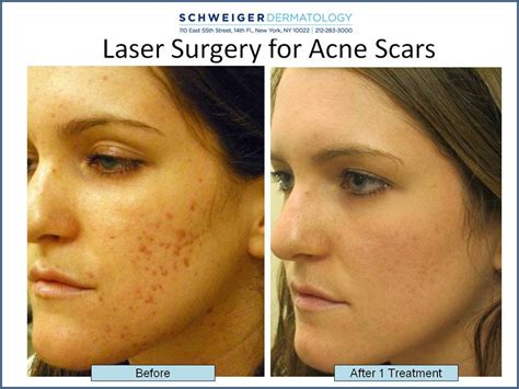 How to Treat Deep Pitted Acne Scars, Fractional CO2 Laser for Scars