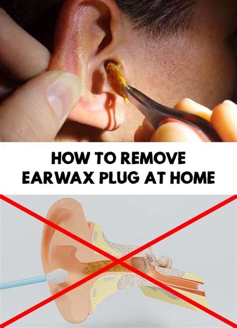 How To Remove Earwax Plug At Home (With images) | Cleaning your ears, Clean ear wax out, Ear wax