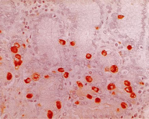 Gastrointestinal Neuroendocrine Lesions | Abdominal Key