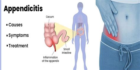 Knowing The Red Flags for Appendicitis