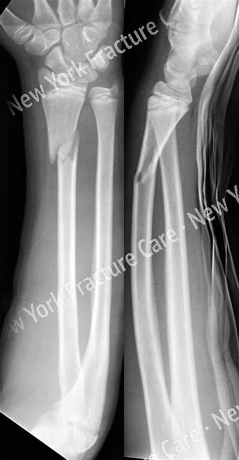 Pediatric fractures - New York Fracture Care