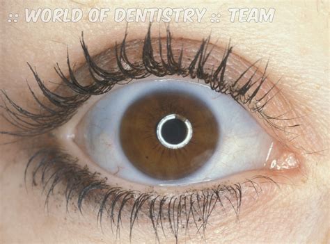 :: World Of Dentistry ::: Blue Sclera "Definition and Diseases"