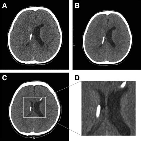 Fifteen years after VP shunt brain CT shows slit-like ventricle. In ...