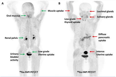 Normal Pet Scan Images