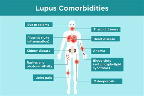 Diagnosing Lupus