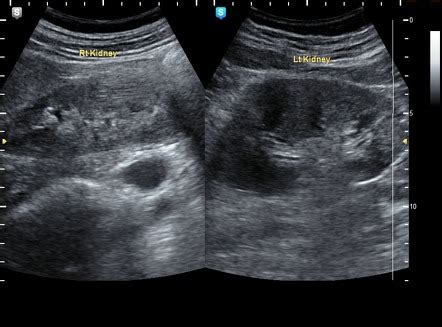 Pyelonephritis Ultrasound