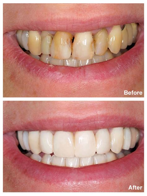 Are Veneers Bad For Your Teeth? - Sedation and Implant Dentistry of ...