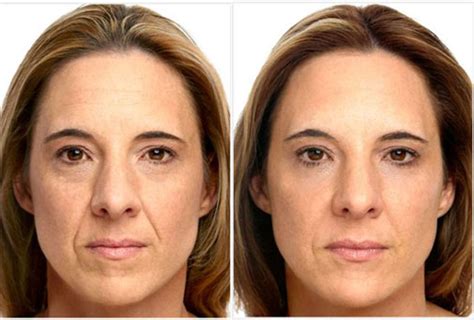 BOTOX BEFORE AND AFTER - Desmotsdart | image-blog