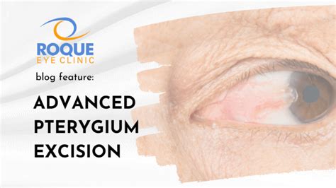 Pterygium Excision - ROQUE Eye Clinic | Eye.com.ph