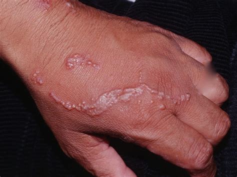 Poison Ivy Rash - Causes, How To Identify Poison Ivy Rash & Treatment