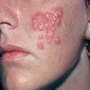 Cold Sore on the Cheek (Advice That You Need to Know) - Cold Sores Cured