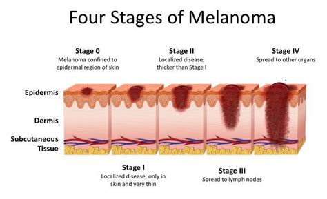 Stage 4 Melanoma Skin Cancer