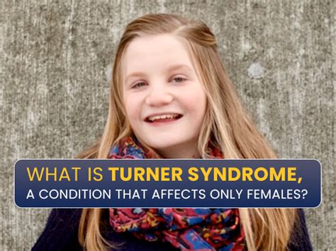 Turner Syndrome: Causes, Symptoms, Complications And Treatments - Boldsky.com