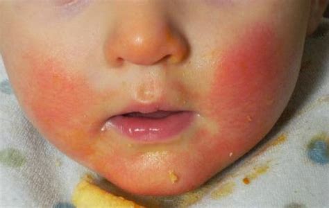 Teething Rash - Pictures, Causes, Treatment