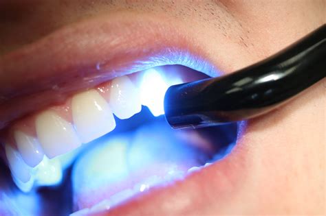 How Does LED Teeth Whitening Work? - Lane & Associates