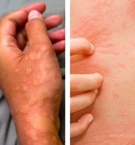 What are Hives (Urticaria)? Investigating This Bizarre Skin Condition