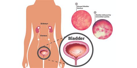 Best Painful Bladder Syndrome Treatment in India – RG Hospital